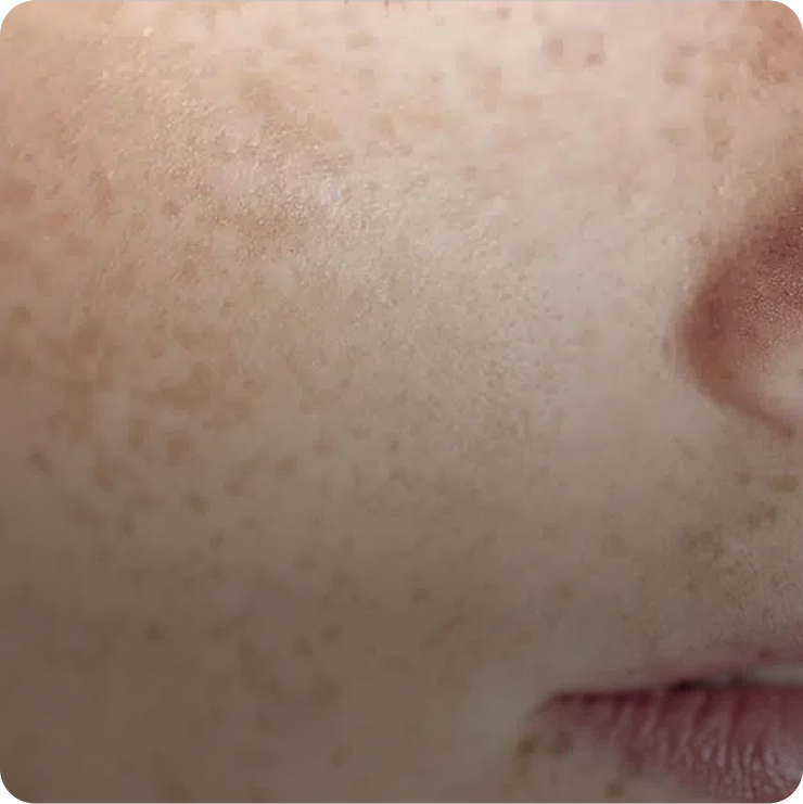 Pigmentation